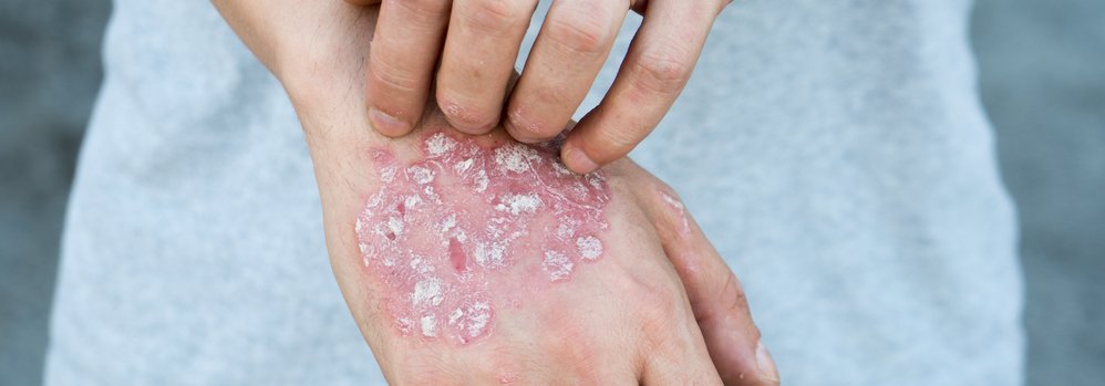 Schuppenflechte Psoriasis Symptome Hände