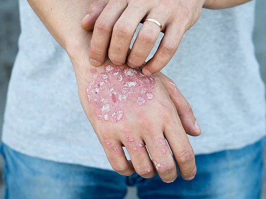 Schuppenflechte Psoriasis Symptome Hände