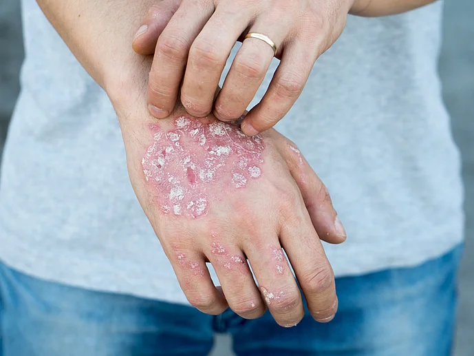 Schuppenflechte Psoriasis Symptome Hände