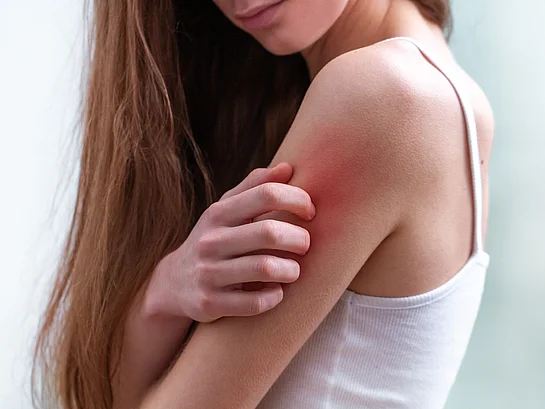 Neurodermitis Atopische Dermatitis Juckreiz