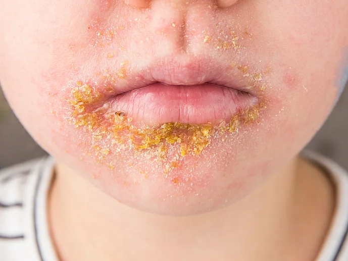 Borkenflechte Eiterflechte Impetigo Ursachen Behandlung