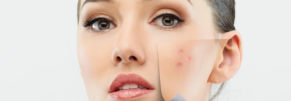 Hautprobleme Akne Hautpflege unreine Haut Spätakne