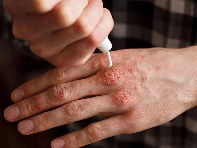 Psoriasis an den Händen Hautpflege
