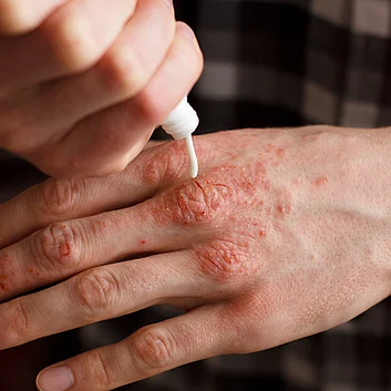 Psoriasis an den Händen Hautpflege