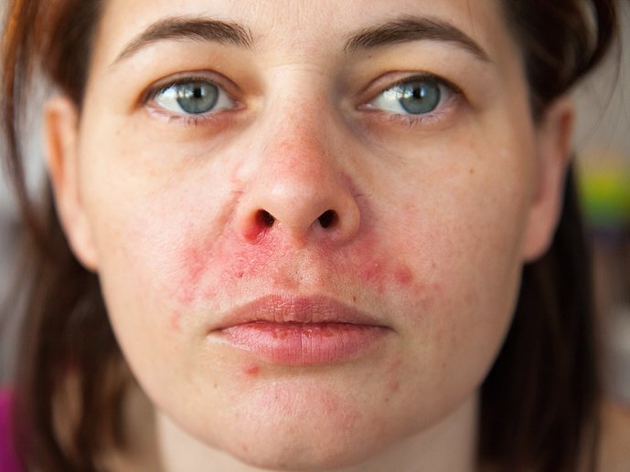 Periorale Dermatitis Mundrose