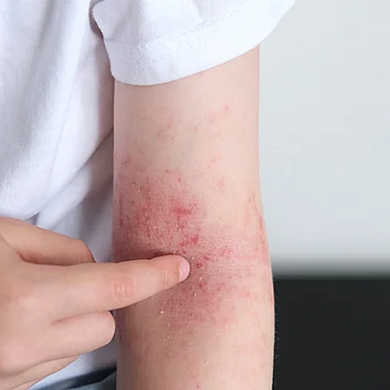 Atopische Dermatitis (Neurodermitis) bei jungem Mann