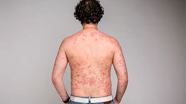 Schuppenflechte Psoriasis Symptome Rücken Plaques trockene rote Haut