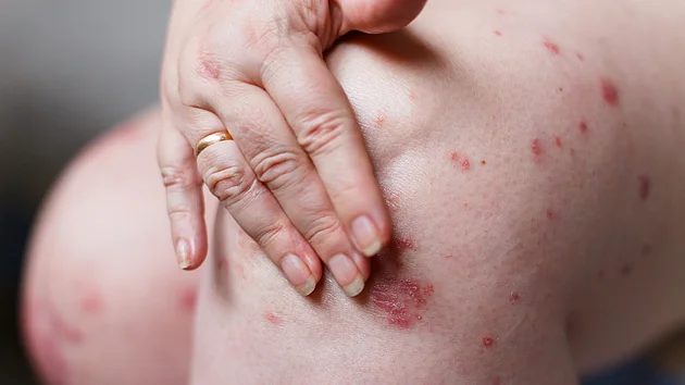 Psoriasis im Alltag