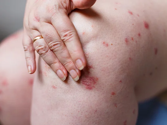 Psoriasis im Alltag