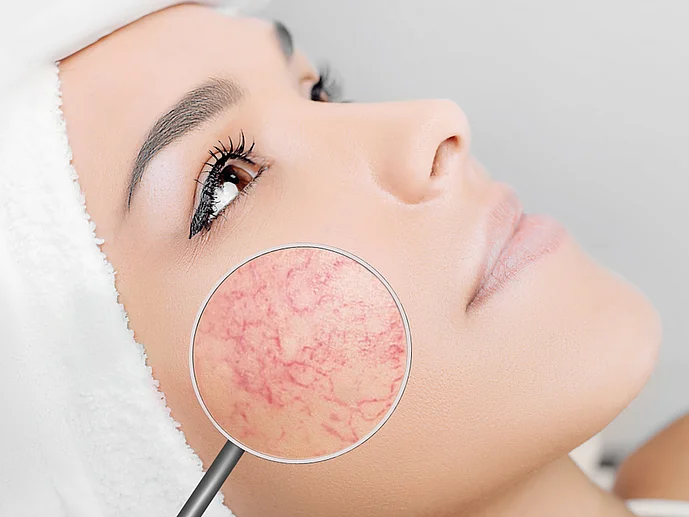Couperose Rosacea ursache und behandlung