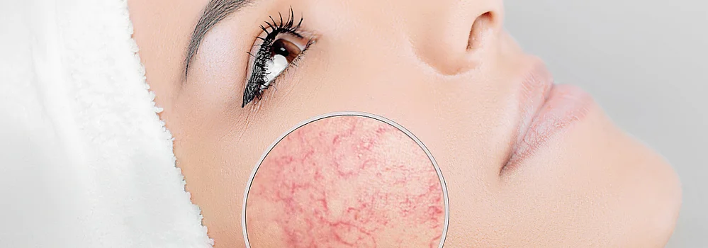 Couperose Rosacea ursache und behandlung