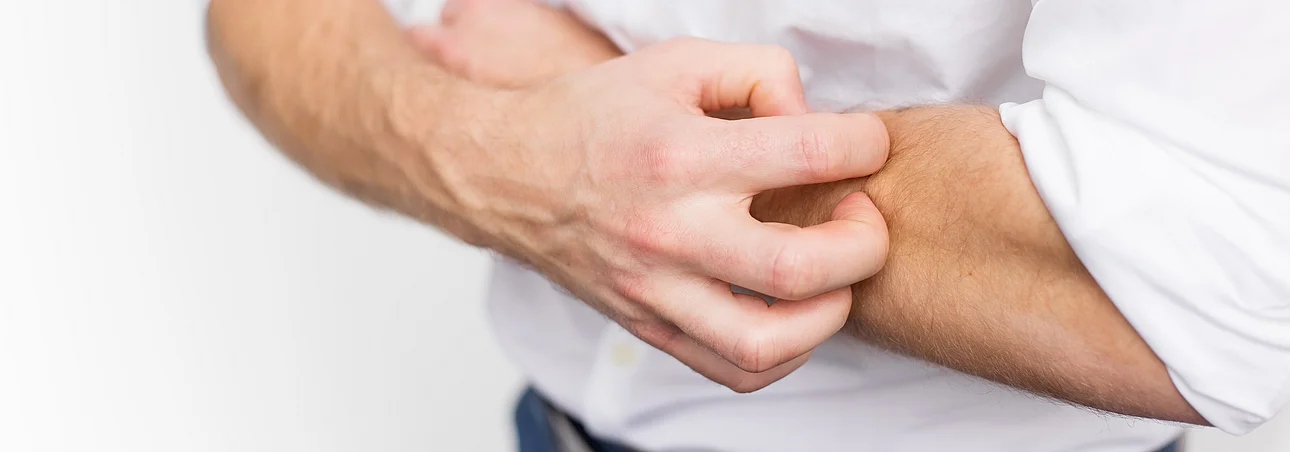 Starker Juckreiz Prurigo Nodularis bei jungen Mann