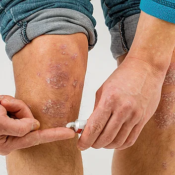 Man cremt Cortsion auf Schuppenflechte Plaques am Beim