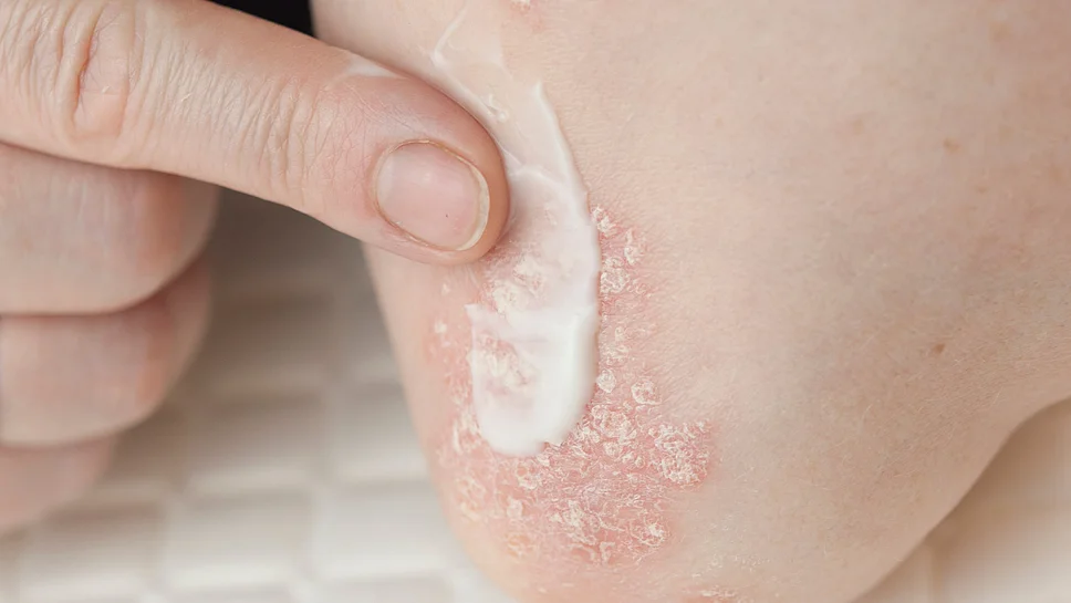 Psoriasis Schuppenflechte topische Pflege
