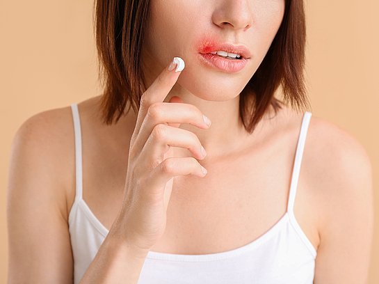 Junge Frau mit Fieberblase mit Fieberblasencreme