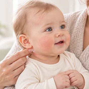 Neurodermitis Atopisches Ekzem Baby