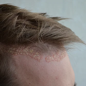 Psoriasis Schuppenflechte Kopf Haaransatz Symptome