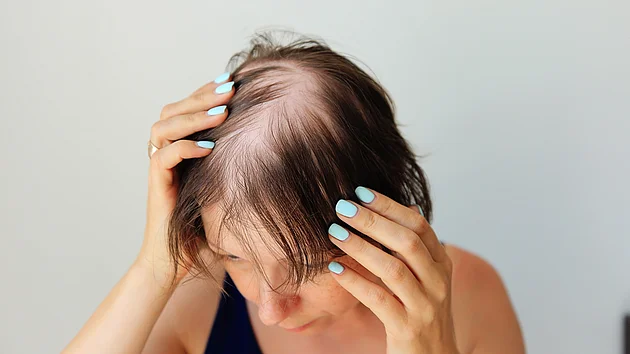 Haarausfall dünnes Haar