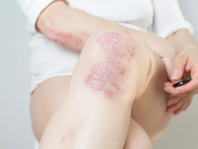Psorasis Schuppenflechte Symptome am Knie