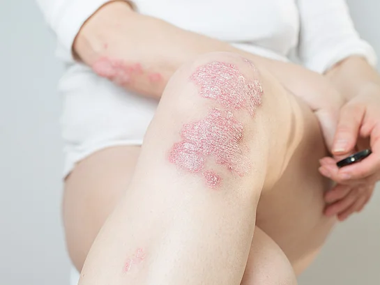Psorasis Schuppenflechte Symptome am Knie