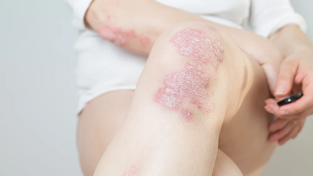 Psorasis Schuppenflechte Symptome am Knie