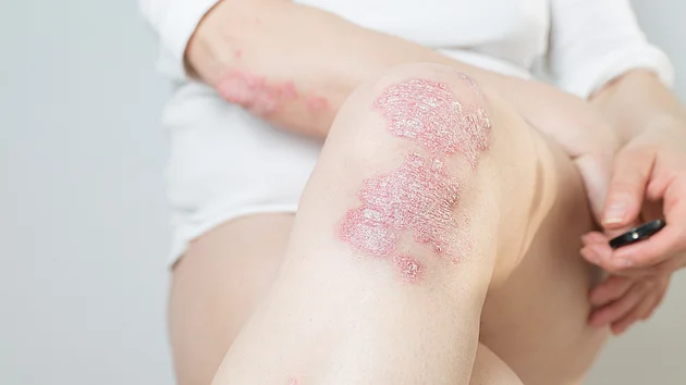 Psorasis Schuppenflechte Symptome am Knie