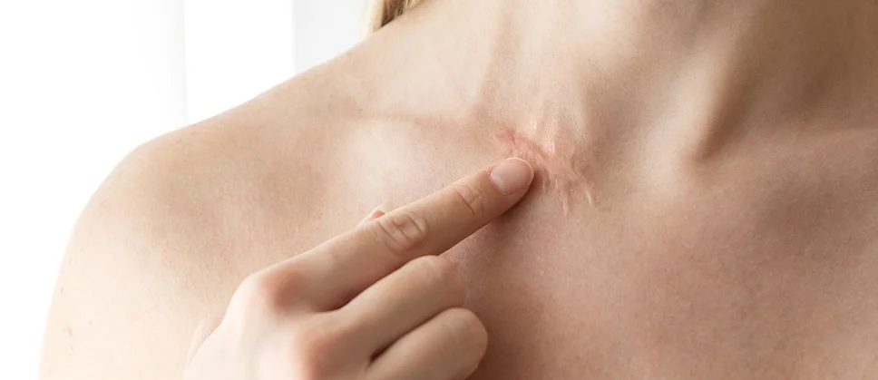 Narbenbehandlung Narbenkorrektur Lasertherapie bei Narben