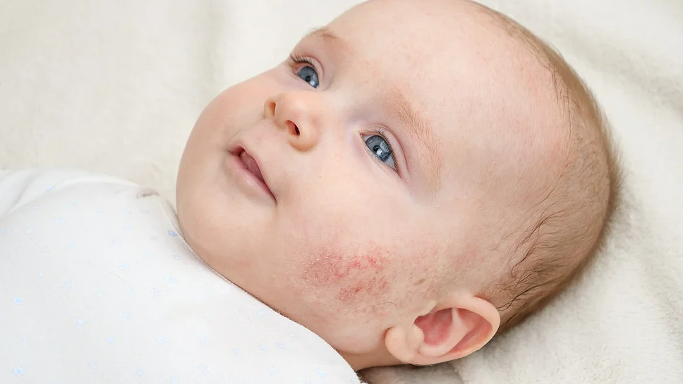 Neurodermitis Baby