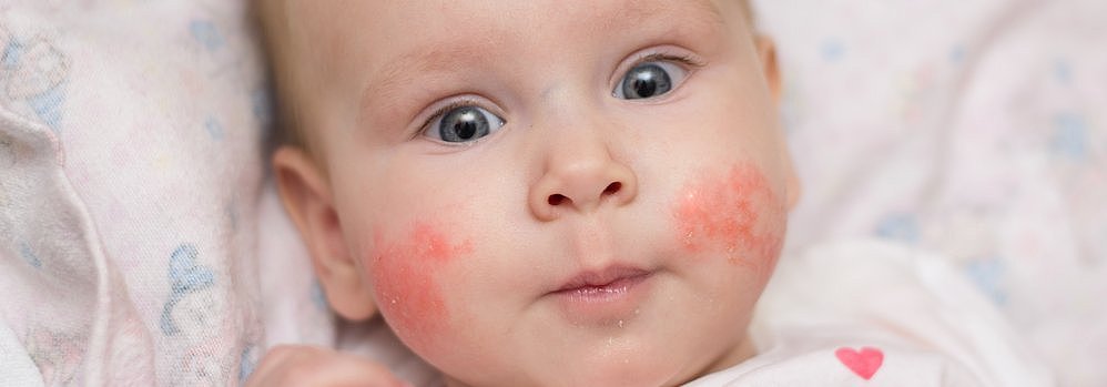Neurodermitis beim Baby richtige Hautpflege