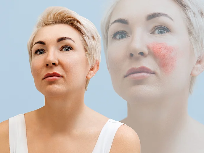Rosacea im Winter richtig pflegen