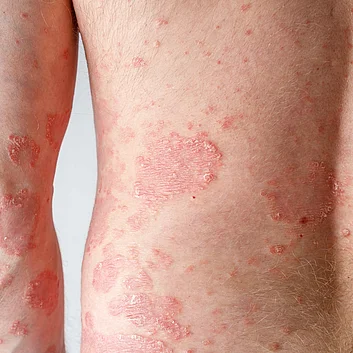 Psoriasis Schuppenflechte Plaques am Koerper