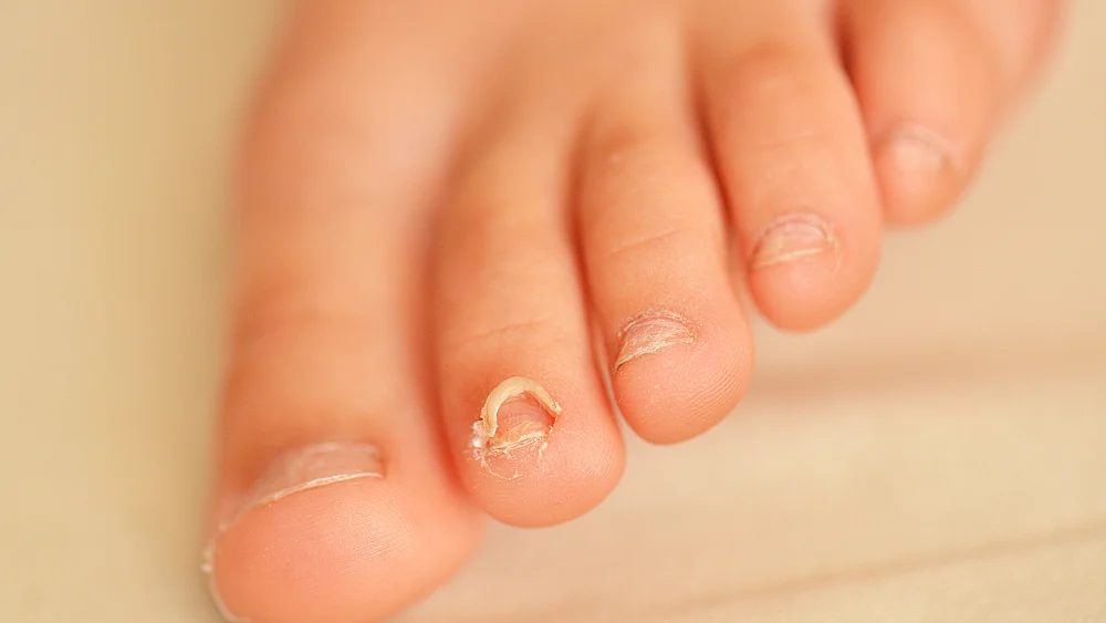 Nagelpilz heilen