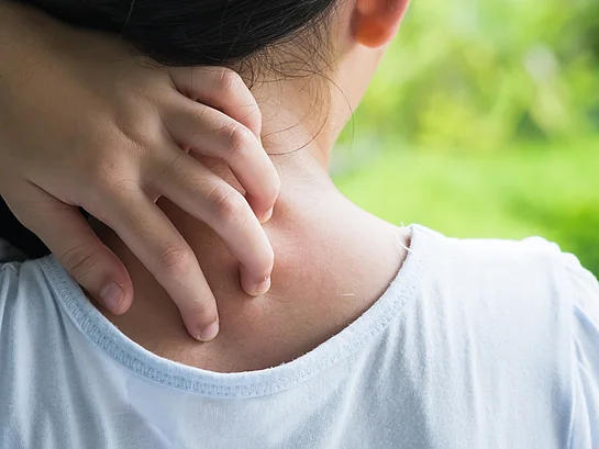 Neurodermitis Kind Baby Juckreiz behandeln cortisonfrei