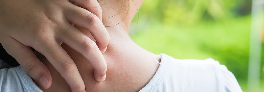 Neurodermitis Kind Baby Juckreiz behandeln cortisonfrei