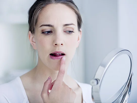 Herpes Gesicht Frau