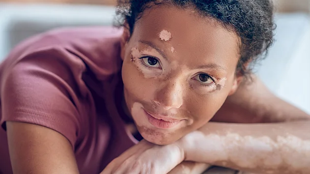 Vitiligo im Gesicht und an den Armen junge Frau 
