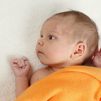 Neurodermitis Baby Symptome cortisonfrei