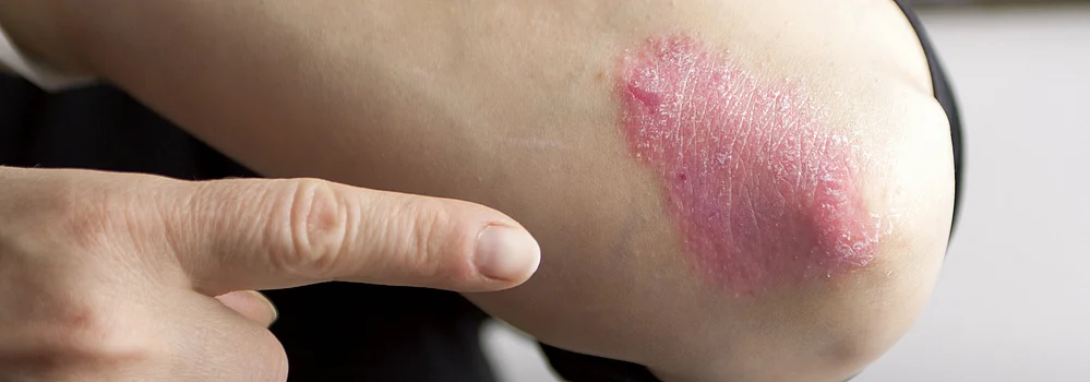 Psoriasis Schuppenflechte Arm Juckreiz Behandlung Therapie