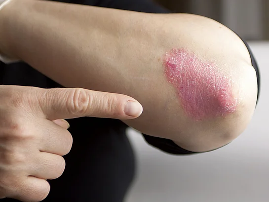 Psoriasis Schuppenflechte Arm Juckreiz Behandlung Therapie