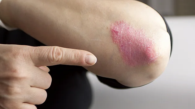 Psoriasis Schuppenflechte Arm Juckreiz Behandlung Therapie