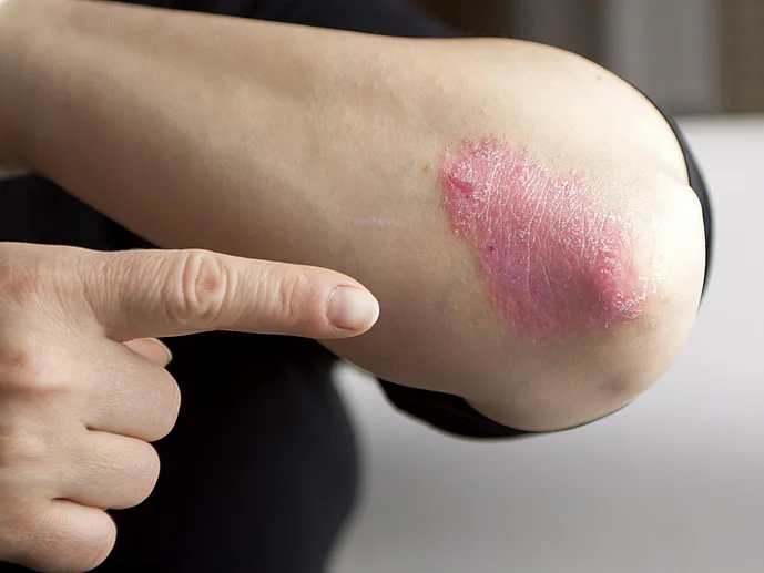 Psoriasis Schuppenflechte Arm Juckreiz Behandlung Therapie