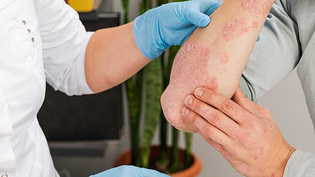 Psoriasis Schuppenflechte Psoriasisbehandlung Schuppenflechtetherapie