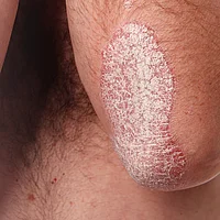 Psoriasis Schuppenflechte Symptome Ellbeugen Schuppen