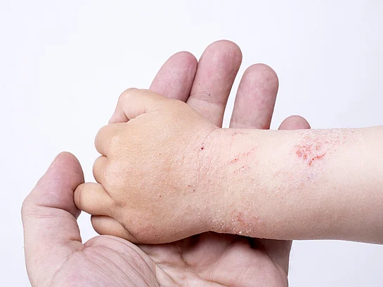 Neurodermitis Kind Baby Juckreiz Symptome cortisonfrei