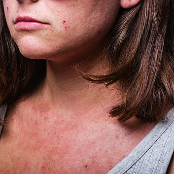 Junge Frau mit Neurodermitis richtige Hautpflege