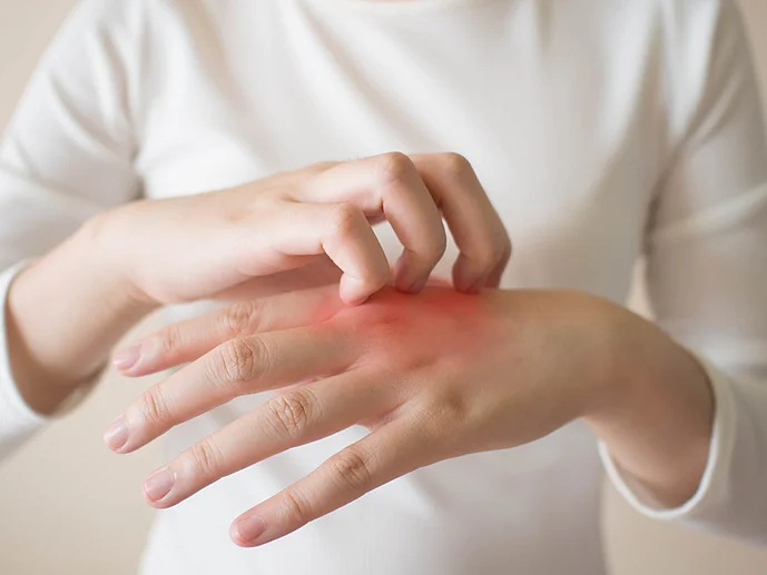 Neurodermitis Atopische Dermatitis Juckreiz Biologikum