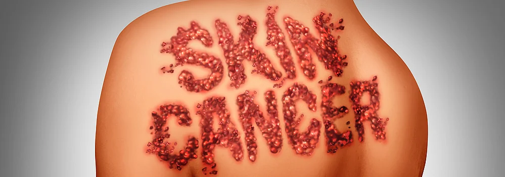 skincancer Hautkrebs Sonnenschäden an der Haut