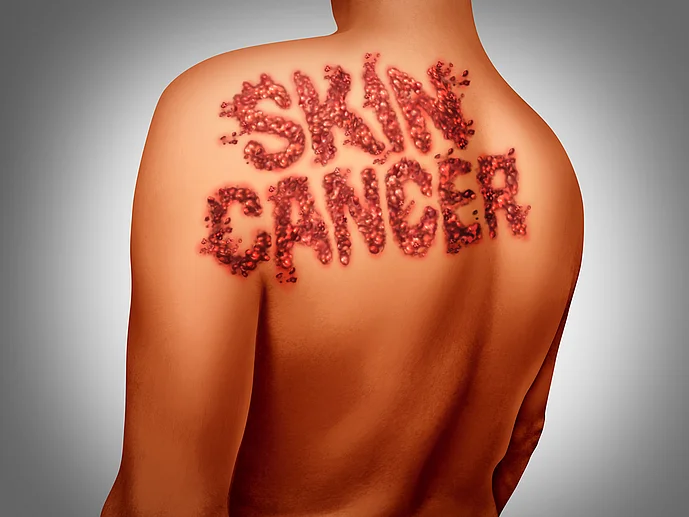 skincancer Hautkrebs Sonnenschäden an der Haut