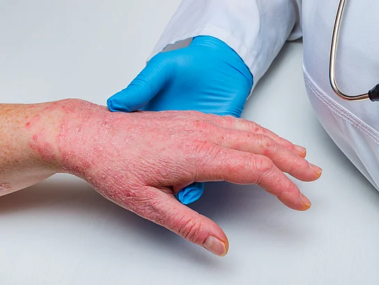 Neurodermitis Schulmedizin Behandlung