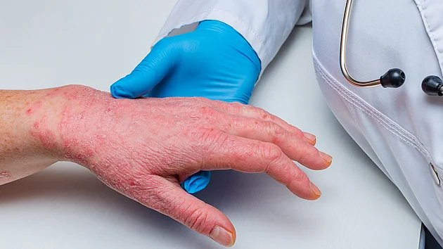 Neurodermitis Schulmedizin Behandlung